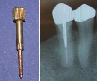 Nordin Metal Screw Post
