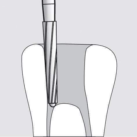 Denco Endo-Z Bur
