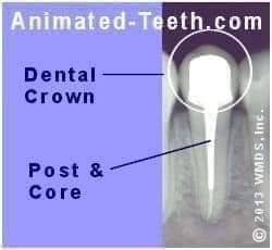 Nordin Metal Screw Post